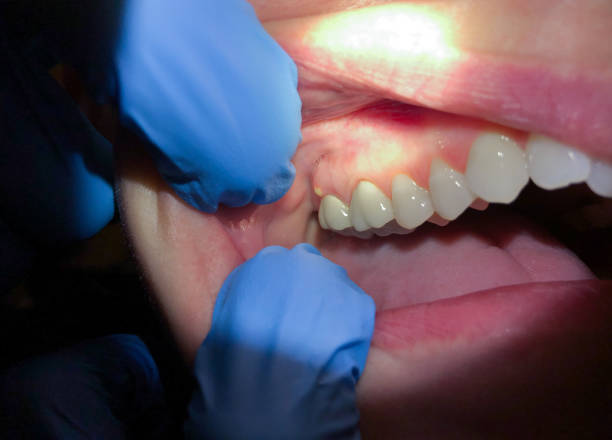 Best Emergency Dental Care for Broken or Chipped Teeth in Mcconnellstown, PA